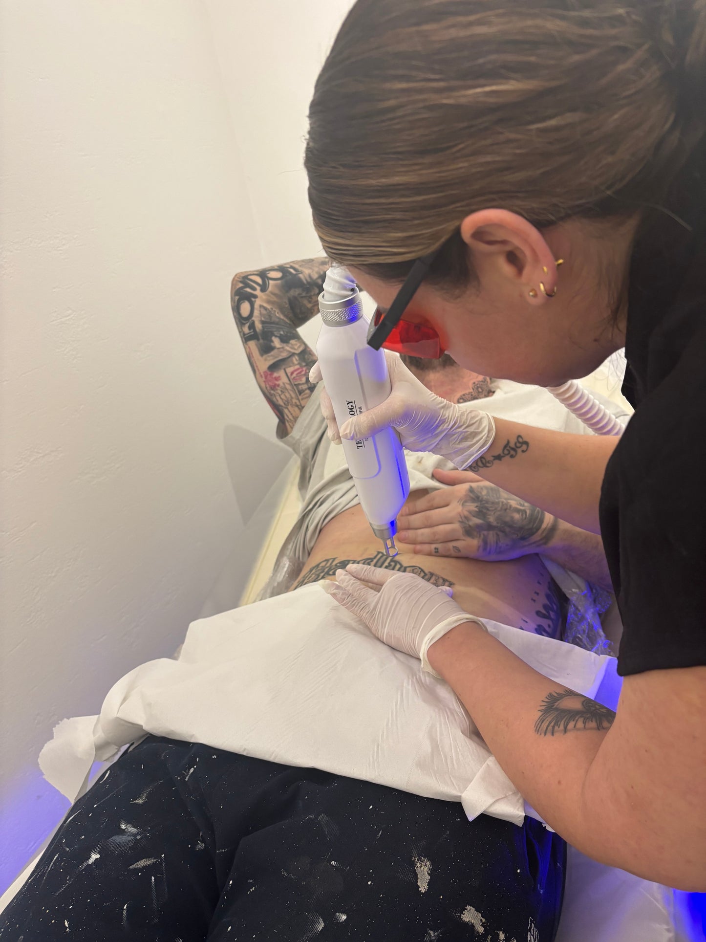Laser Tattoo Removal