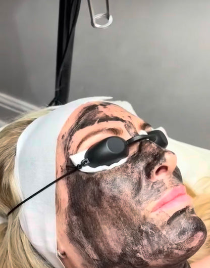 Carbon Facial (Laser)