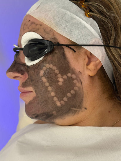 Carbon Facial (Laser)