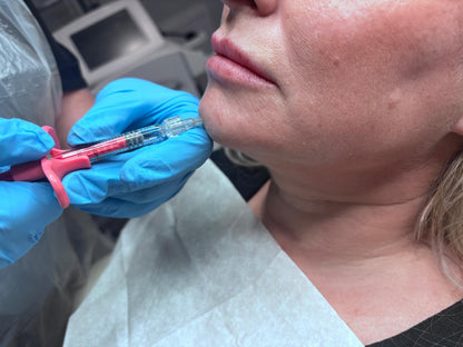 Dermal Fillers