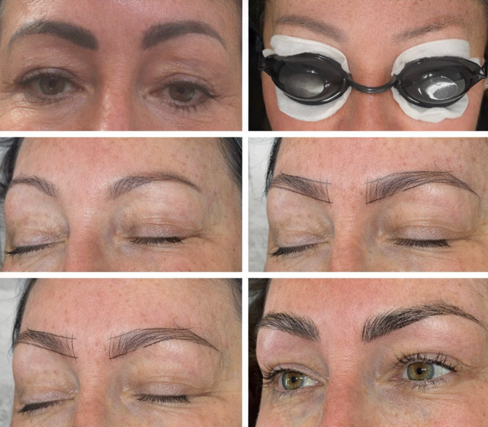 Laser Tattoo Removal