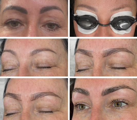 Laser Tattoo Removal