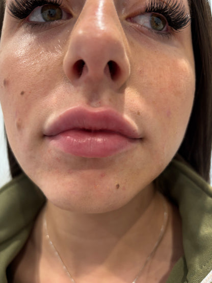 Dermal Fillers