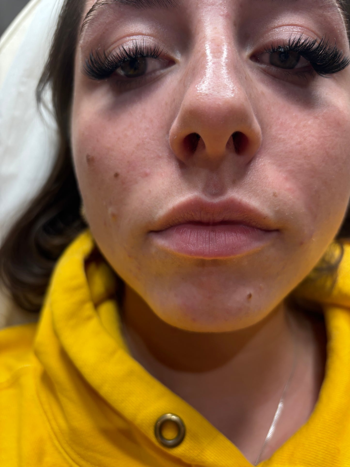 Dermal Fillers