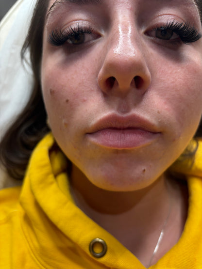 Dermal Fillers