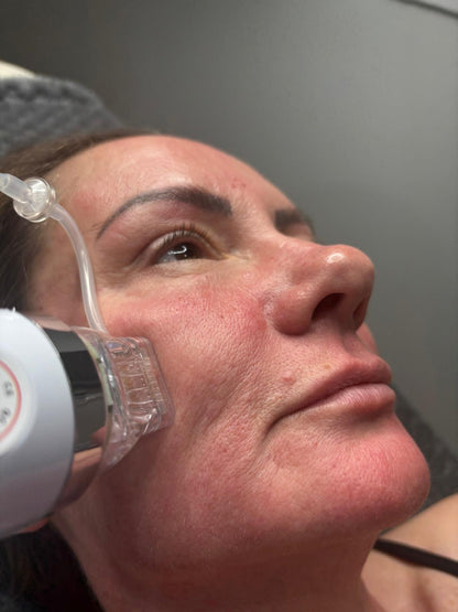 Radio Frequency Microneedling