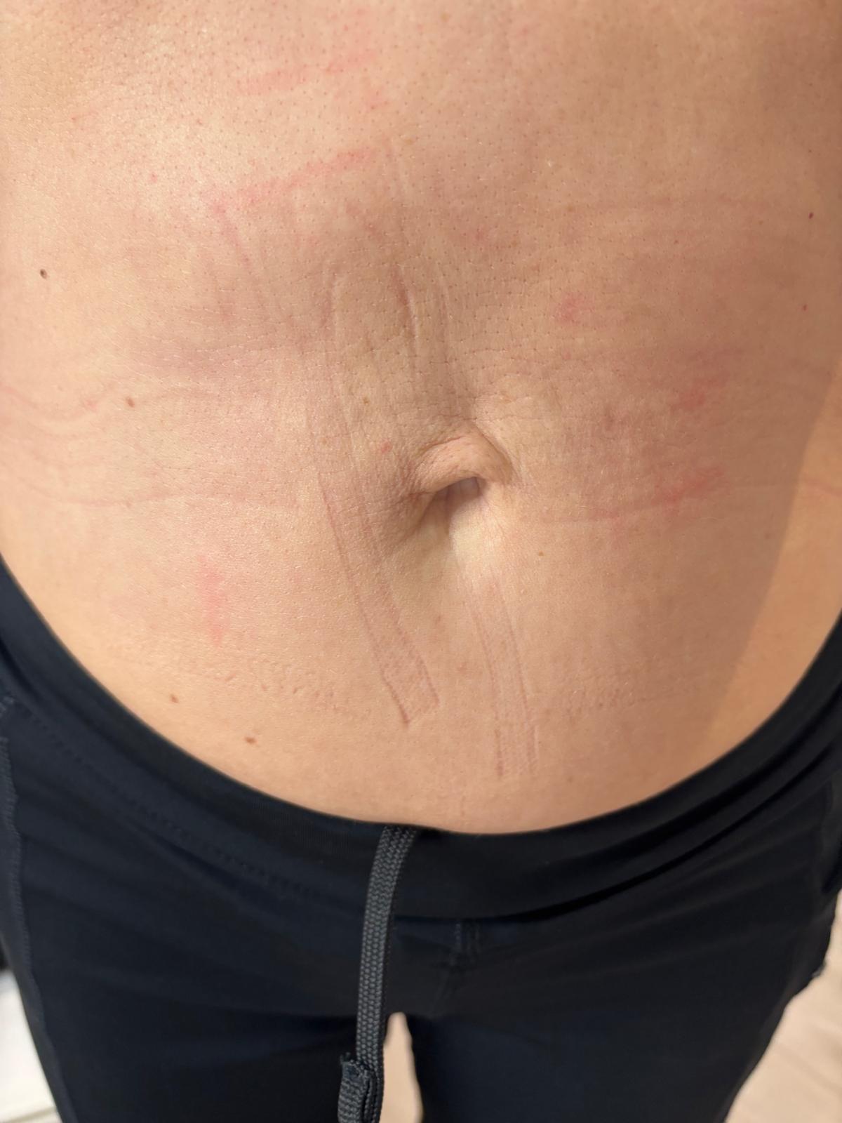 Radio Frequency Microneedling
