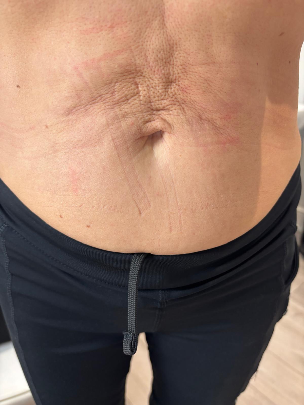Radio Frequency Microneedling