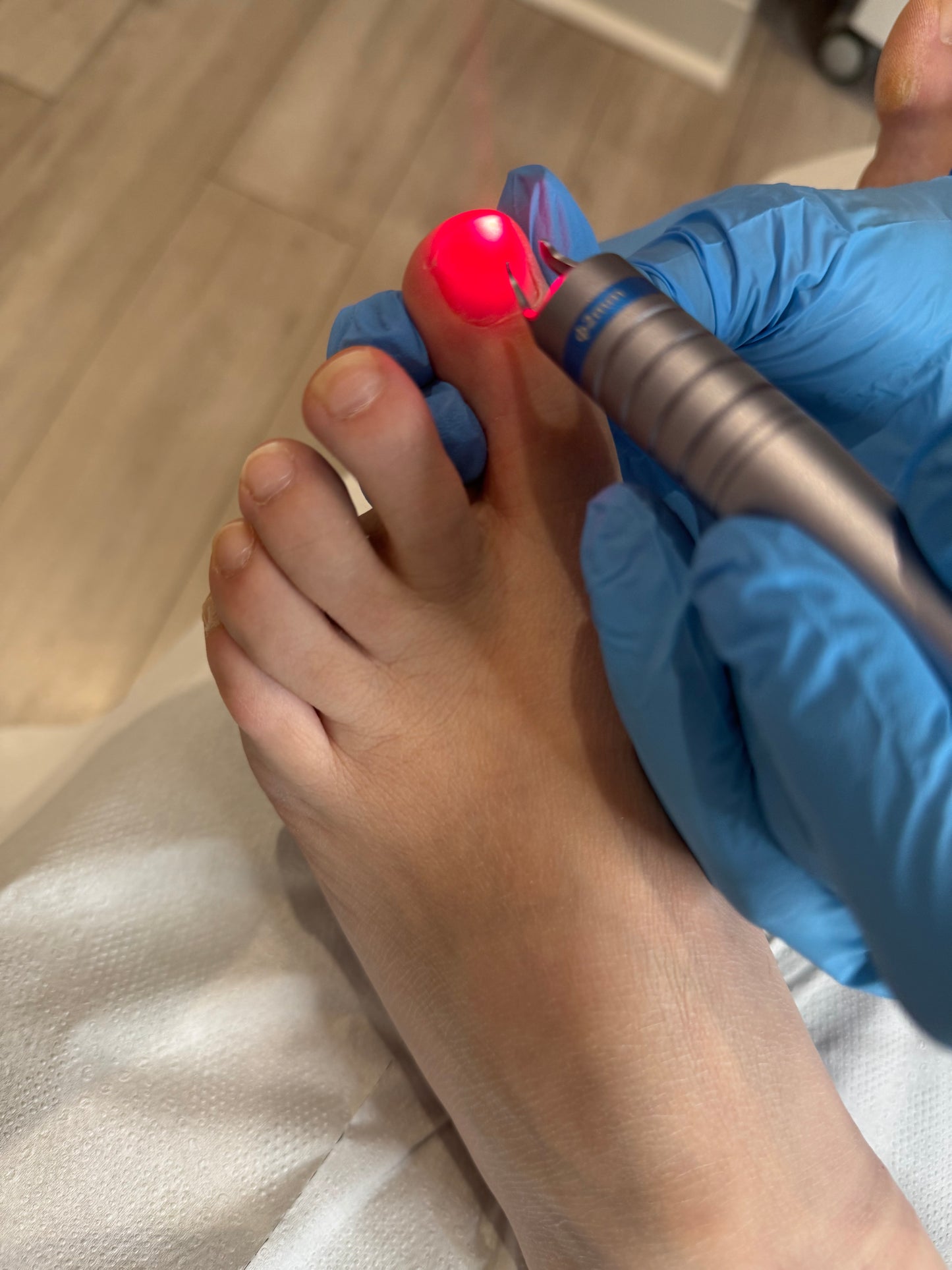 Fungal Toenail