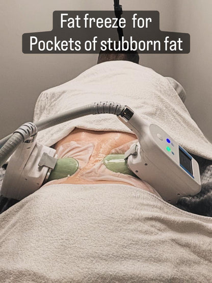 Body Sculpture Fat Freeze (Cryolipolysis)