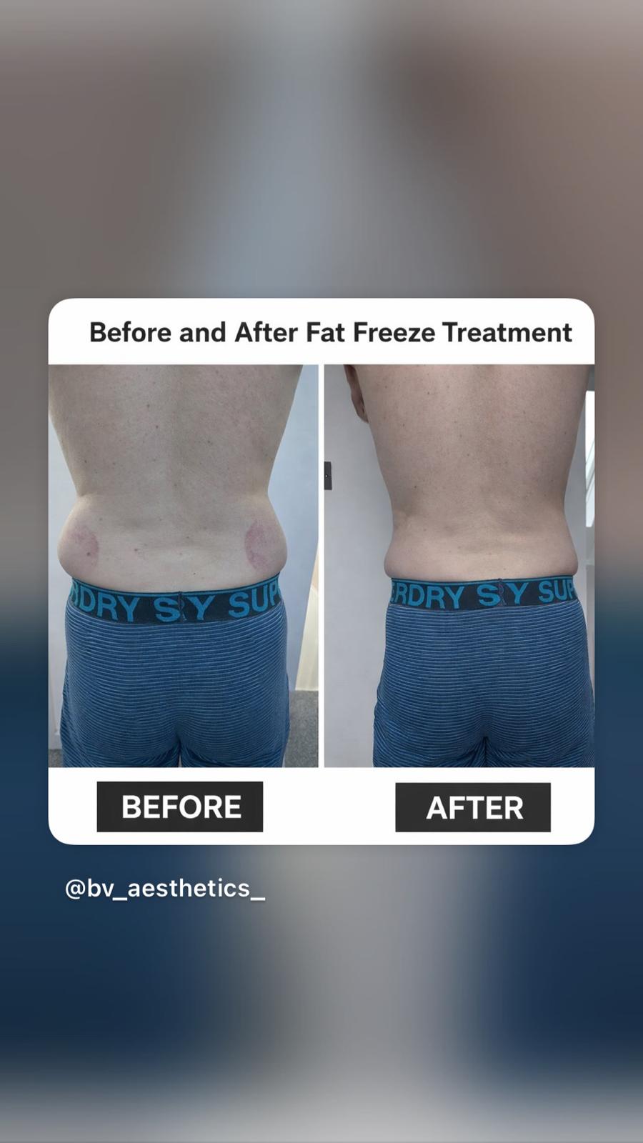 Body Sculpture Fat Freeze (Cryolipolysis)