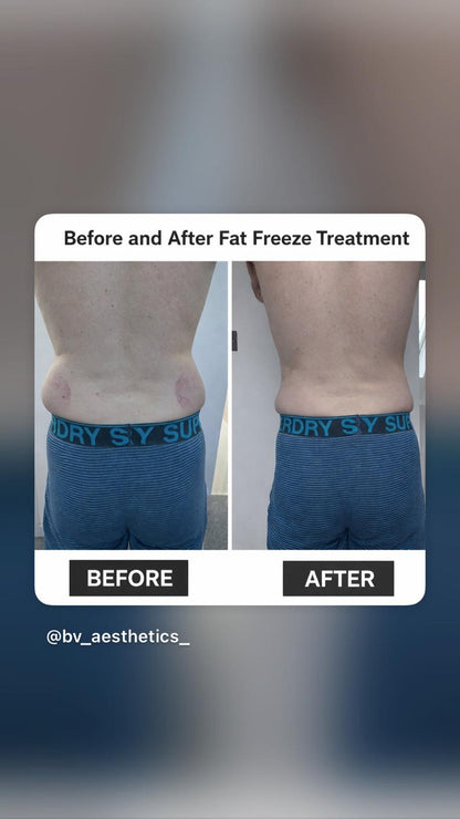 Body Sculpture Fat Freeze (Cryolipolysis)