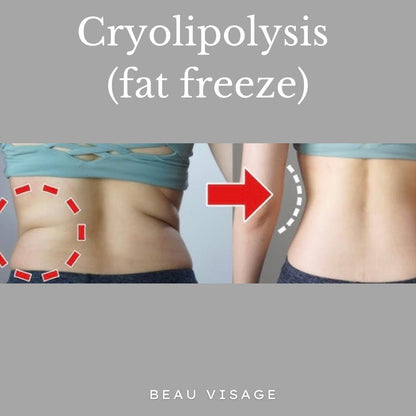 Body Sculpture Fat Freeze (Cryolipolysis)