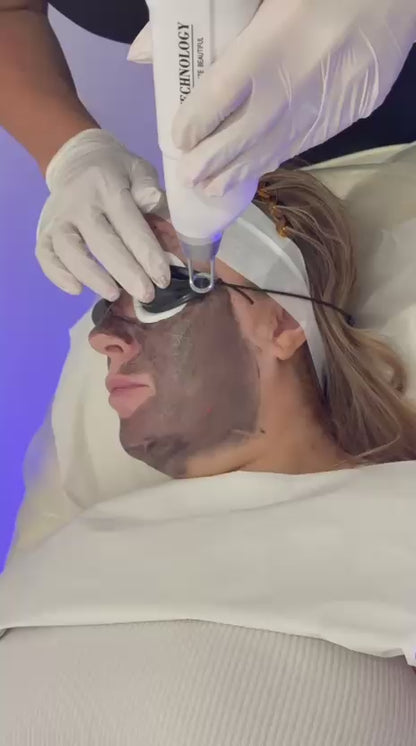 Carbon Facial (Laser)