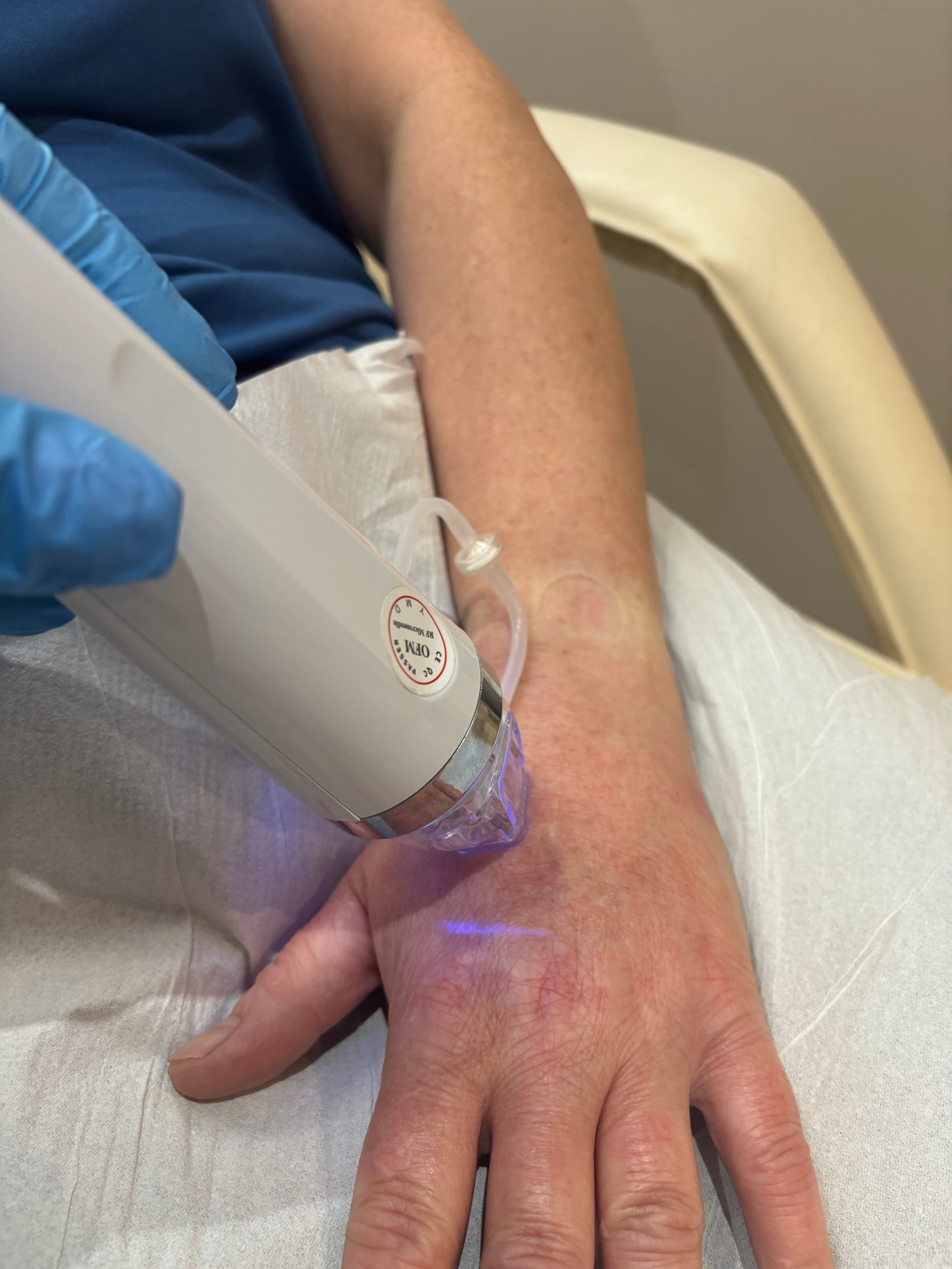Radio Frequency Microneedling