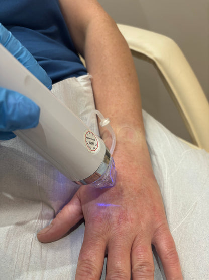 Radio Frequency Microneedling